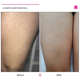 LASER HAIR REMOVAL - Female - Before and After