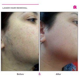 LASER HAIR REMOVAL - Female - Before and After