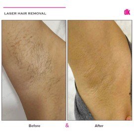 LASER HAIR REMOVAL - Female - Before and After