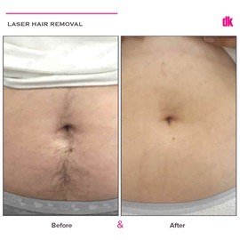 LASER HAIR REMOVAL - Female - Before and After