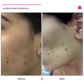 LASER HAIR REMOVAL - Female - Before and After