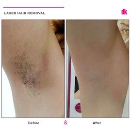 LASER HAIR REMOVAL - Female - Before and After