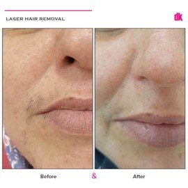 LASER HAIR REMOVAL - Female - Before and After
