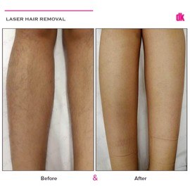 LASER HAIR REMOVAL - Female - Before and After