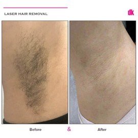 LASER HAIR REMOVAL - Female - Before and After