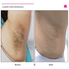 LASER HAIR REMOVAL - Female - Before and After