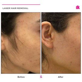 LASER HAIR REMOVAL - Female - Before and After