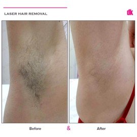 LASER HAIR REMOVAL - Female - Before and After