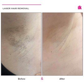 LASER HAIR REMOVAL - Female - Before and After