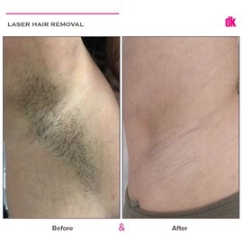 LASER HAIR REMOVAL - Female - Before and After