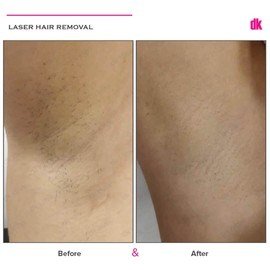 LASER HAIR REMOVAL - Female - Before and After