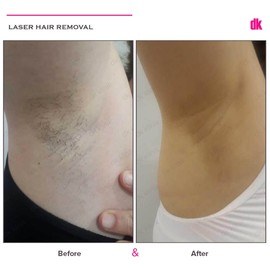 LASER HAIR REMOVAL - Female - Before and After