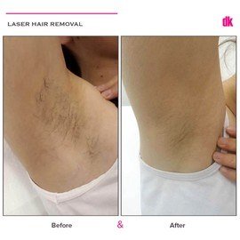 LASER HAIR REMOVAL - Female - Before and After
