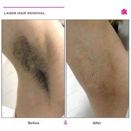 LASER HAIR REMOVAL - Female - Before and After