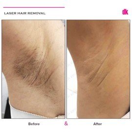 LASER HAIR REMOVAL - Female - Before and After