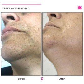LASER HAIR REMOVAL - Female - Before and After