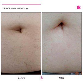 LASER HAIR REMOVAL - Female - Before and After