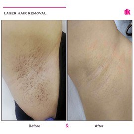 LASER HAIR REMOVAL - Female - Before and After