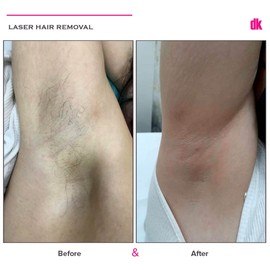 LASER HAIR REMOVAL - Female - Before and After