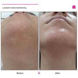 LASER HAIR REMOVAL - Female - Before and After
