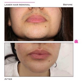 LASER HAIR REMOVAL - Female - Before and After