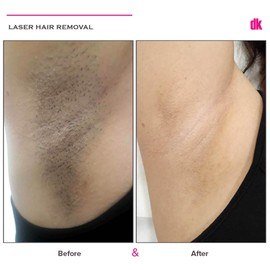 LASER HAIR REMOVAL - Female - Before and After
