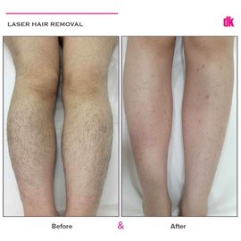 LASER HAIR REMOVAL - Female - Before and After