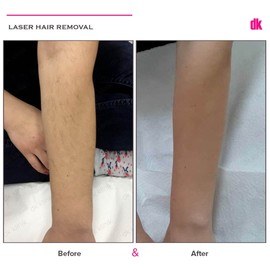 LASER HAIR REMOVAL - Female - Before and After