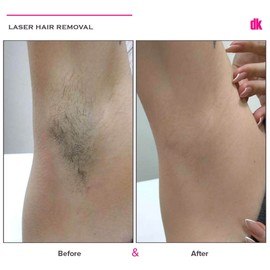 LASER HAIR REMOVAL - Female - Before and After