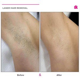 LASER HAIR REMOVAL - Female - Before and After