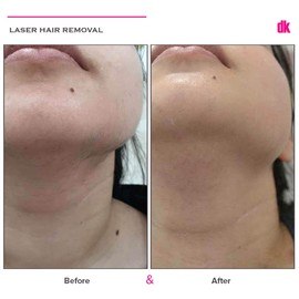 LASER HAIR REMOVAL - Female - Before and After