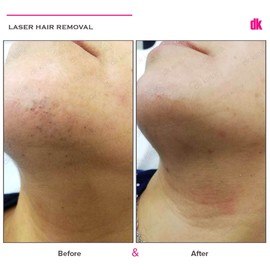 LASER HAIR REMOVAL - Female - Before and After