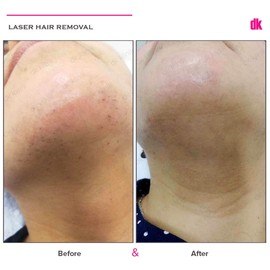 LASER HAIR REMOVAL - Female - Before and After