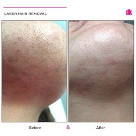 LASER HAIR REMOVAL - Female - Before and After