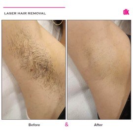 LASER HAIR REMOVAL - Female - Before and After