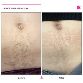LASER HAIR REMOVAL - Female - Before and After