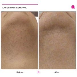 LASER HAIR REMOVAL - Female - Before and After