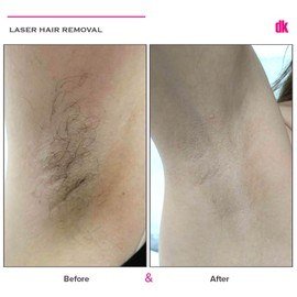 LASER HAIR REMOVAL - Female - Before and After