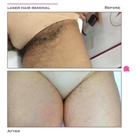 LASER HAIR REMOVAL - Female - Before and After