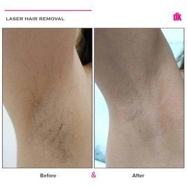 LASER HAIR REMOVAL - Female - Before and After