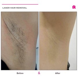 LASER HAIR REMOVAL - Female - Before and After