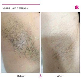 LASER HAIR REMOVAL - Female - Before and After