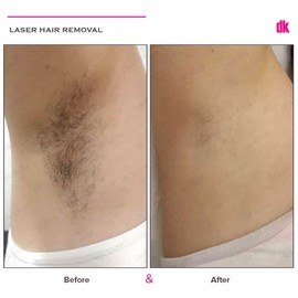 LASER HAIR REMOVAL - Female - Before and After
