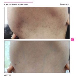 LASER HAIR REMOVAL - Female - Before and After