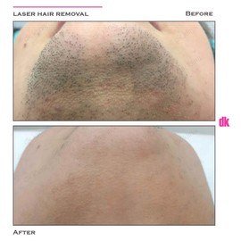 LASER HAIR REMOVAL - Female - Before and After