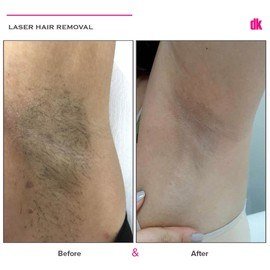 LASER HAIR REMOVAL - Female - Before and After
