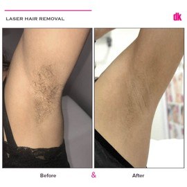 LASER HAIR REMOVAL - Female - Before and After