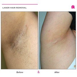 LASER HAIR REMOVAL - Female - Before and After