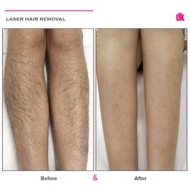 LASER HAIR REMOVAL - Female - Before and After