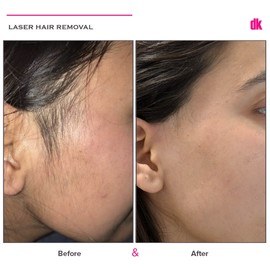 LASER HAIR REMOVAL - Female - Before and After